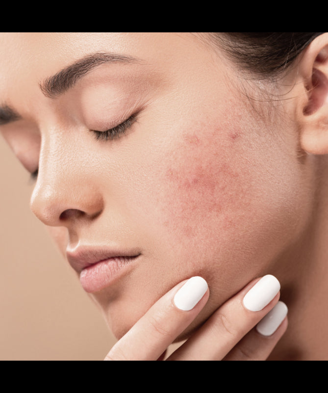 MLADÉ - SOS PUMPLES - Tea Tree Oil