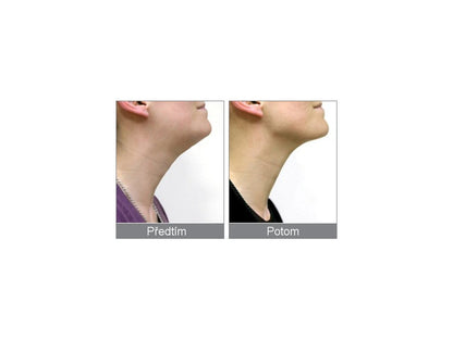 Rio Beauty Hals- und Kinnstraffungsgerät lila NECK4