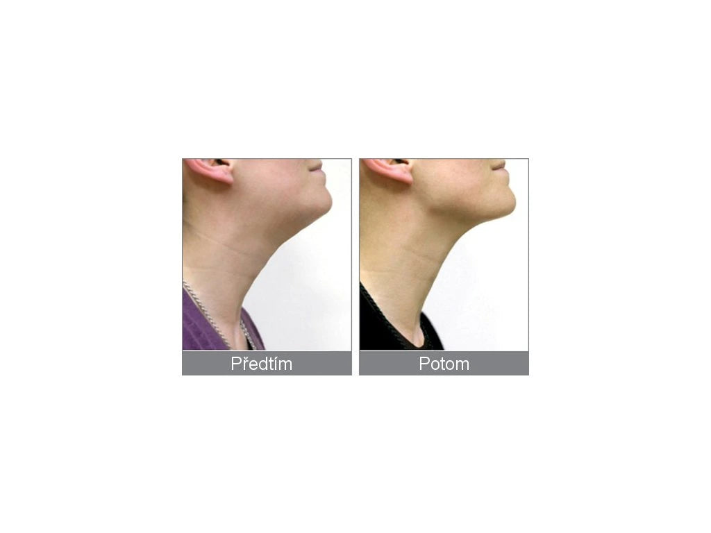 Rio Beauty Hals- und Kinnstraffungsgerät NECK4